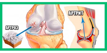 Беспокоит артроз? – Выход есть! Воздействуем не только на боль, но и на ее причины.