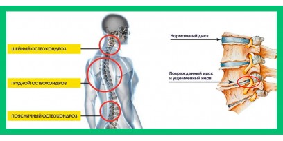 Остеохондроз: что нужно знать каждому